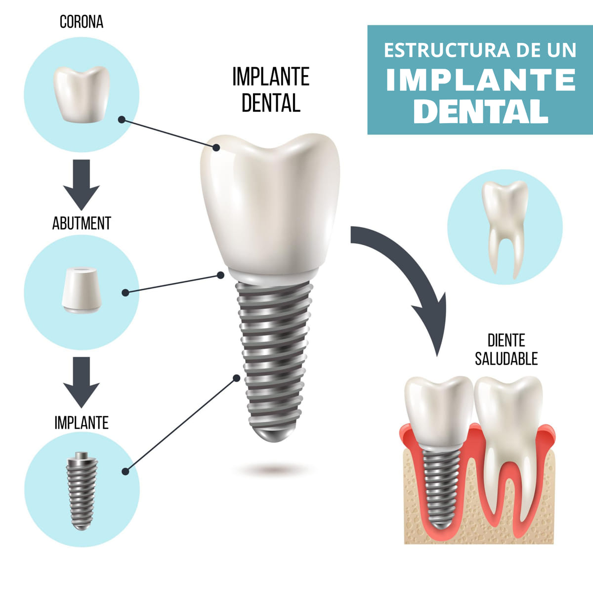 Implante-Dental