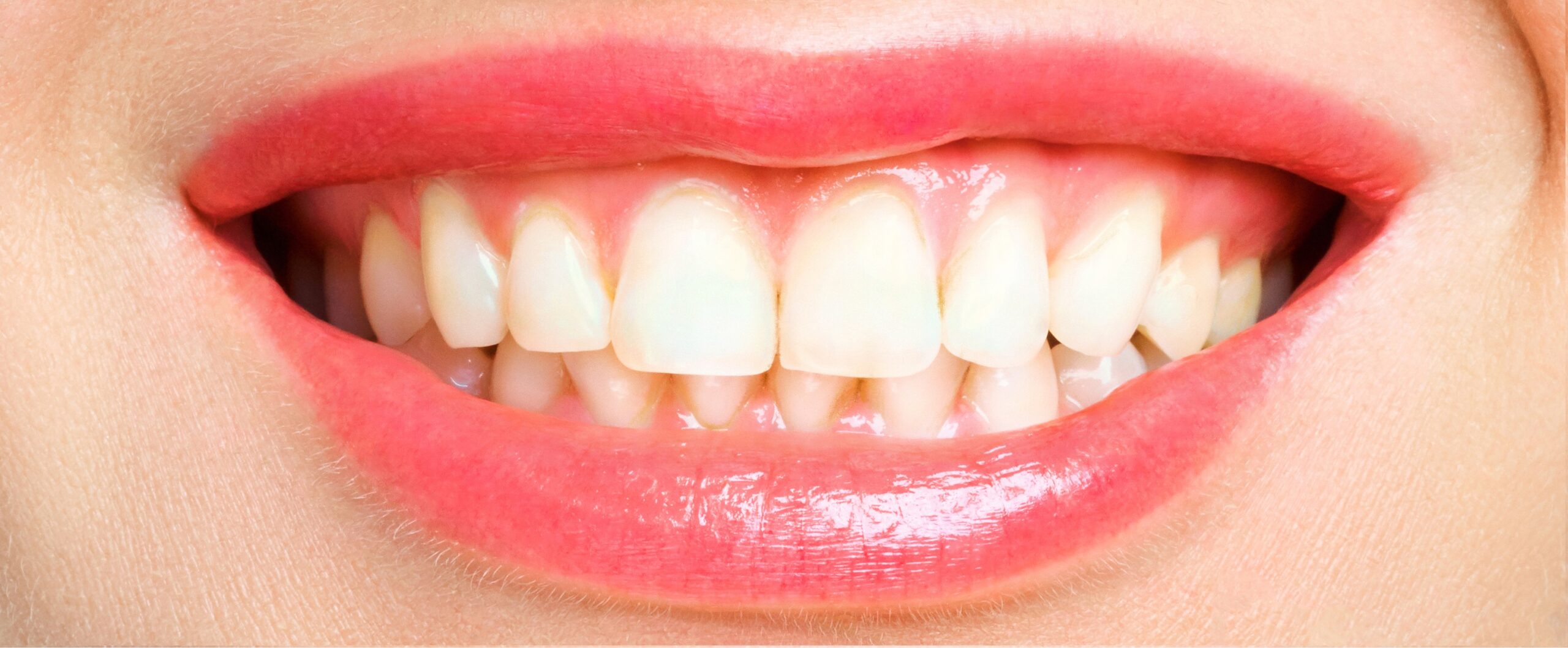 woman teeth before and after whitening. Over white background. Dental clinic patient. Image symbolizes oral care dentistry, stomatology.