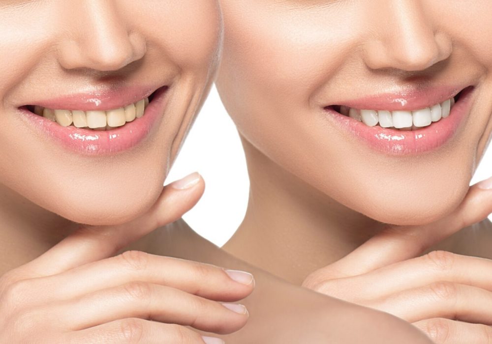 woman smile before and after whitening teeth or applying dental Veneers