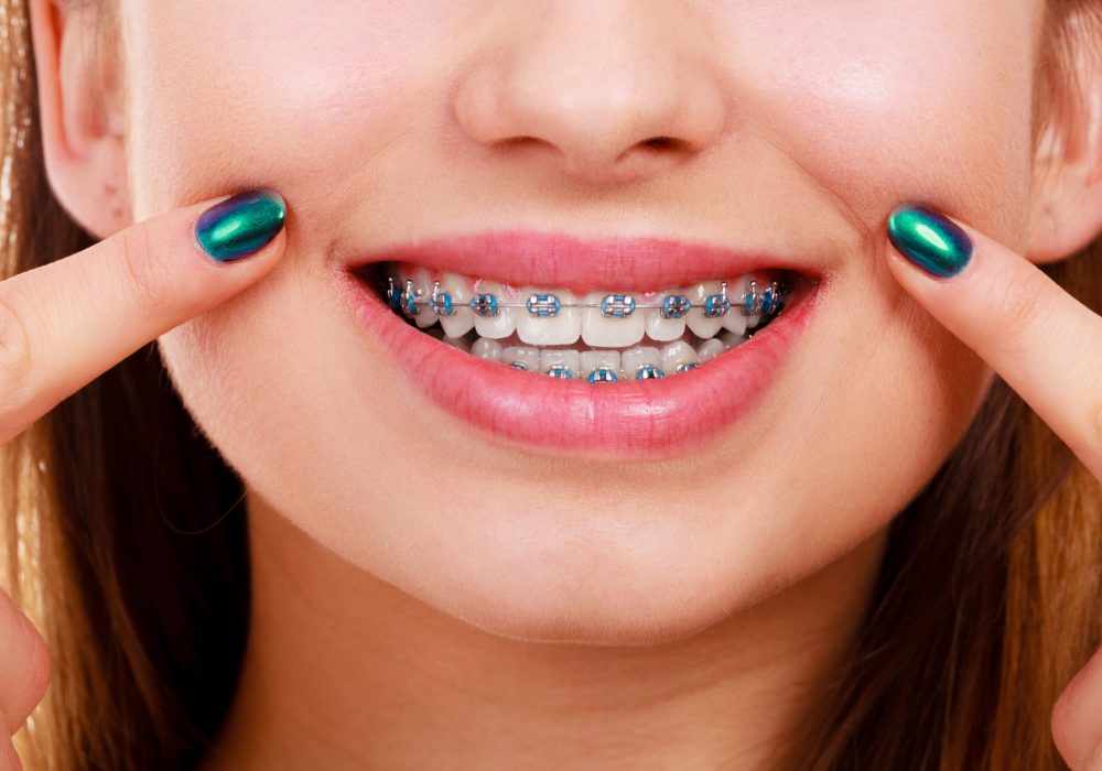 Dentist and orthodontist concept. Woman smile showing her white teeth with blue braces